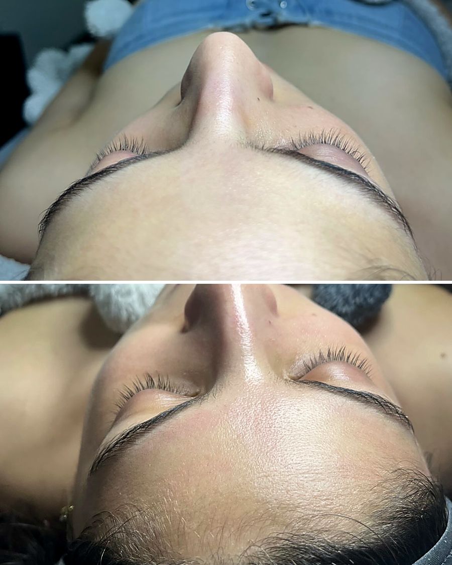 Antes y después de limpieza facial con dermapen